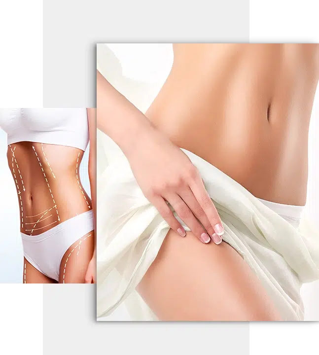 Bauchdeckenstraffung (Abdominoplastik) Kassel